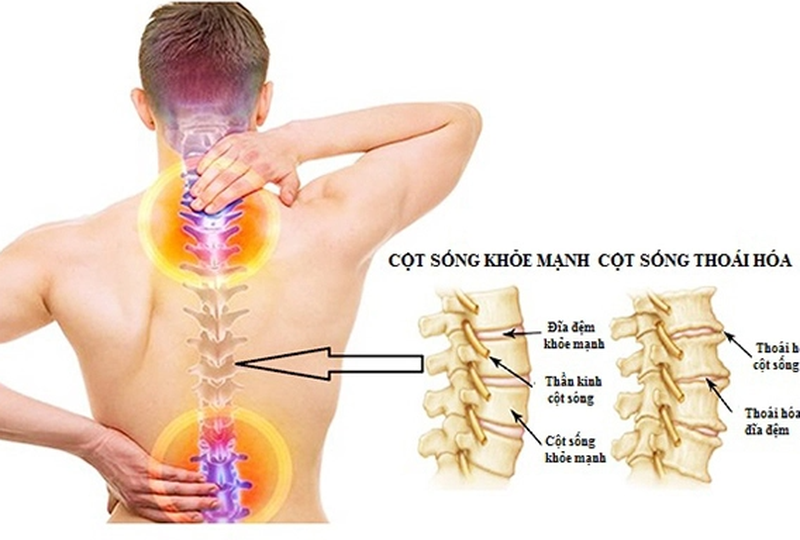 CHỮA THOÁI HOÁ CỘT SỐNG BẰNG CỦ NGẢI ĐEN TỰ NHIÊN