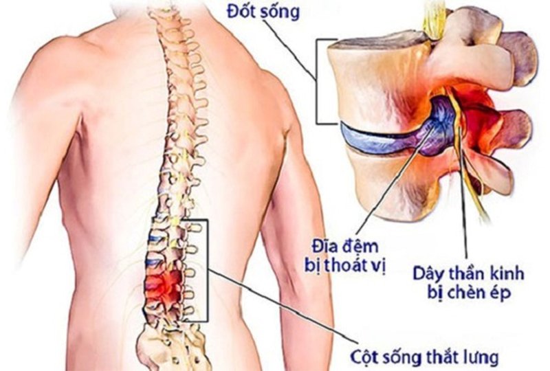 CHỮA THOÁT VỊ ĐĨA ĐỆM BẰNG NGẢI ĐEN BẠN ĐÃ BIẾT CHƯA ?